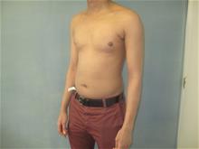 Male Breast Reduction After Photo by Mordcai Blau, MD; White Plains, NY - Case 29322