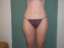 Liposuction After Photo by Mordcai Blau, MD; White Plains, NY - Case 7388