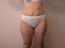 Liposuction Before Photo by Mordcai Blau, MD; White Plains, NY - Case 7388