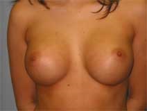 Breast Augmentation After Photo by Paul Zwiebel, MD, DMD; Highlands Ranch, CO - Case 2839