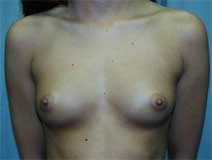 Breast Augmentation Before Photo by Paul Zwiebel, MD, DMD; Highlands Ranch, CO - Case 2839