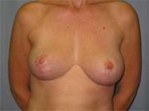Breast Reduction After Photo by Paul Zwiebel, MD, DMD; Highlands Ranch, CO - Case 2853