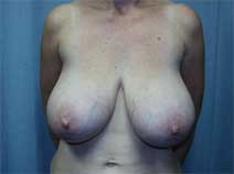Breast Reduction Before Photo by Paul Zwiebel, MD, DMD; Highlands Ranch, CO - Case 2853
