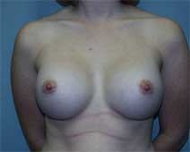 Breast Augmentation After Photo by Paul Zwiebel, MD, DMD; Highlands Ranch, CO - Case 2964