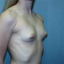 Breast Augmentation Before Photo by Paul Zwiebel, MD, DMD; Highlands Ranch, CO - Case 2964
