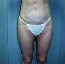 Liposuction After Photo by Paul Zwiebel, MD, DMD; Highlands Ranch, CO - Case 3002