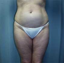 Liposuction Before Photo by Paul Zwiebel, MD, DMD; Highlands Ranch, CO - Case 3002
