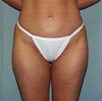 Liposuction After Photo by Paul Zwiebel, MD, DMD; Highlands Ranch, CO - Case 3021