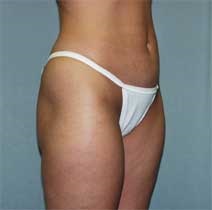 Liposuction After Photo by Paul Zwiebel, MD, DMD; Highlands Ranch, CO - Case 3021