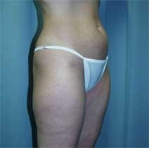 Liposuction Before Photo by Paul Zwiebel, MD, DMD; Highlands Ranch, CO - Case 3021