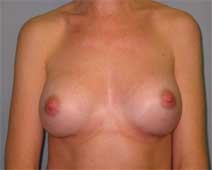 Breast Augmentation After Photo by Paul Zwiebel, MD, DMD; Highlands Ranch, CO - Case 3039