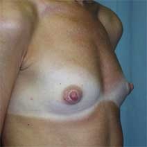 Breast Augmentation Before Photo by Paul Zwiebel, MD, DMD; Highlands Ranch, CO - Case 3039