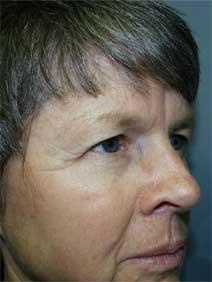 Eyelid Surgery Before Photo by Paul Zwiebel, MD, DMD; Highlands Ranch, CO - Case 3086
