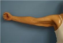 Arm Lift Before Photo by William Lao, MD; New York, NY - Case 33754