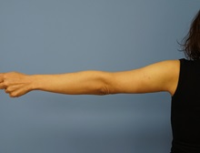 Arm Lift After Photo by William Lao, MD; New York, NY - Case 33754