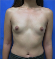 Breast Augmentation Before Photo by William Lao, MD; New York, NY - Case 33755