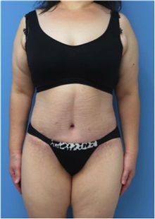 Body Contouring After Photo by William Lao, MD; New York, NY - Case 33756