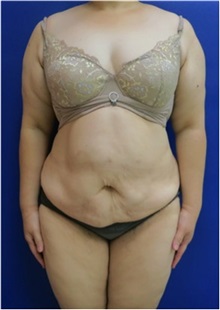 Body Contouring Before Photo by William Lao, MD; New York, NY - Case 33756