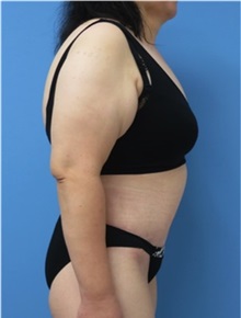 Body Contouring After Photo by William Lao, MD; New York, NY - Case 33756