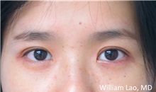 Eyelid Surgery After Photo by William Lao, MD; New York, NY - Case 33757
