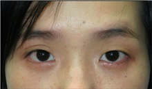 Eyelid Surgery Before Photo by William Lao, MD; New York, NY - Case 33757