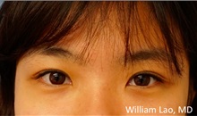 Eyelid Surgery After Photo by William Lao, MD; New York, NY - Case 33758