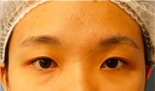 Eyelid Surgery Before Photo by William Lao, MD; New York, NY - Case 33758