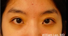Eyelid Surgery After Photo by William Lao, MD; New York, NY - Case 33759
