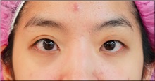 Eyelid Surgery Before Photo by William Lao, MD; New York, NY - Case 33759