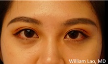 Eyelid Ptosis Repair After Photo by William Lao, MD; New York, NY - Case 33760