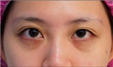 Eyelid Ptosis Repair Before Photo by William Lao, MD; New York, NY - Case 33760