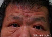 Eyelid Ptosis Repair After Photo by William Lao, MD; New York, NY - Case 33761