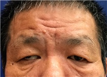 Eyelid Ptosis Repair Before Photo by William Lao, MD; New York, NY - Case 33761