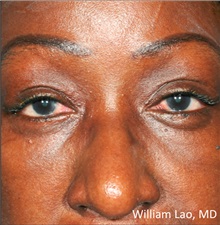 Eyelid Surgery After Photo by William Lao, MD; New York, NY - Case 33763