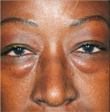 Eyelid Surgery Before Photo by William Lao, MD; New York, NY - Case 33763