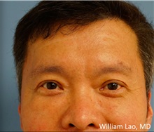 Eyelid Surgery After Photo by William Lao, MD; New York, NY - Case 33764
