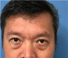 Eyelid Surgery Before Photo by William Lao, MD; New York, NY - Case 33764