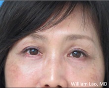 Eyelid Surgery After Photo by William Lao, MD; New York, NY - Case 33765