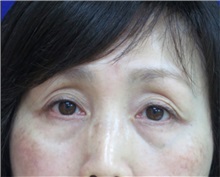 Eyelid Surgery Before Photo by William Lao, MD; New York, NY - Case 33765