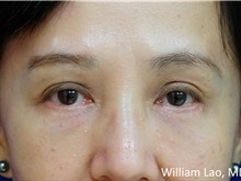 Eyelid Surgery After Photo by William Lao, MD; New York, NY - Case 33766