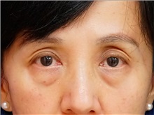 Eyelid Surgery Before Photo by William Lao, MD; New York, NY - Case 33766