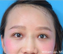 Eyelid Surgery After Photo by William Lao, MD; New York, NY - Case 33767