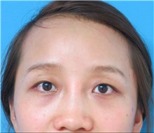 Eyelid Surgery Before Photo by William Lao, MD; New York, NY - Case 33767