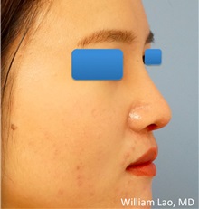 Rhinoplasty After Photo by William Lao, MD; New York, NY - Case 33769