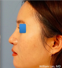 Rhinoplasty After Photo by William Lao, MD; New York, NY - Case 33769