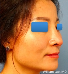 Rhinoplasty After Photo by William Lao, MD; New York, NY - Case 33770