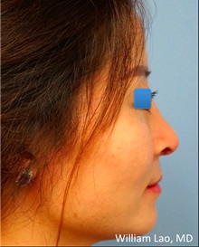 Rhinoplasty After Photo by William Lao, MD; New York, NY - Case 33770