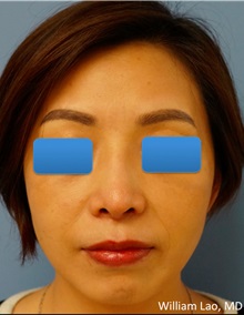 Rhinoplasty After Photo by William Lao, MD; New York, NY - Case 33771