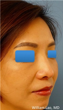 Rhinoplasty After Photo by William Lao, MD; New York, NY - Case 33771