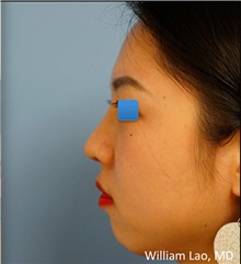 Rhinoplasty After Photo by William Lao, MD; New York, NY - Case 33772